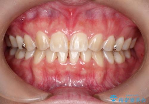 オフィスホワイトニング スタンダードコース の治療前