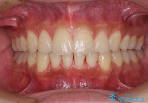 矯正治療の後戻りをインビザライン・ライトで解消の治療中