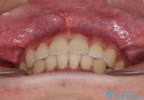 矯正治療の後戻りをインビザライン・ライトで解消の治療中