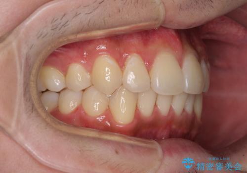 矯正治療の後戻りをインビザライン・ライトで解消の治療中