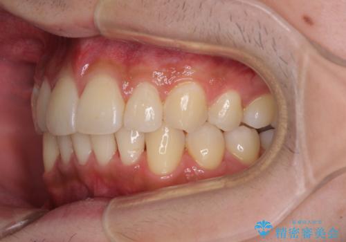 矯正治療の後戻りをインビザライン・ライトで解消の治療中