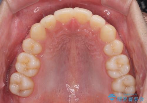 矯正治療の後戻りをインビザライン・ライトで解消の治療中
