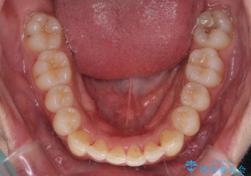 矯正治療の後戻りをインビザライン・ライトで解消の治療中