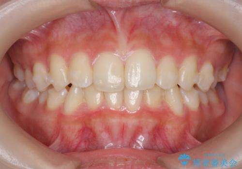 [ インビザラインライト ]   短期間で前歯だけを並べたいの治療中