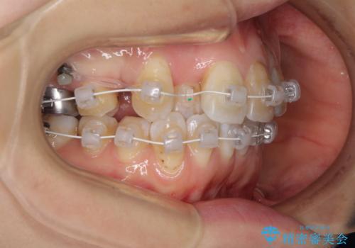 内側にある歯が邪魔 重なった前歯の歯列矯正の治療中