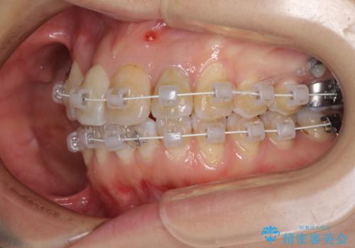 内側にある歯が邪魔 重なった前歯の歯列矯正の治療中
