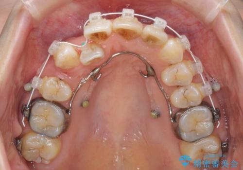 内側にある歯が邪魔　重なった前歯の歯列矯正の治療中