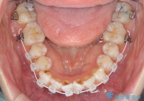 内側にある歯が邪魔 重なった前歯の歯列矯正の治療中