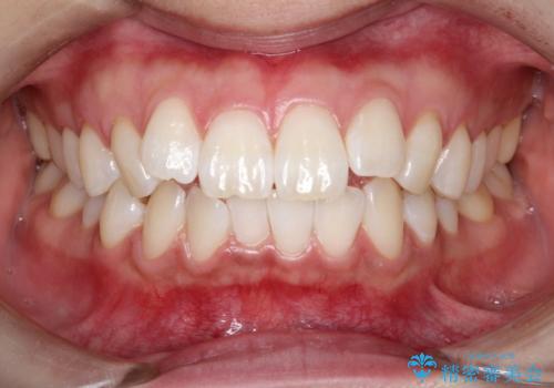 オフィスホワイトニング スタンダードコース