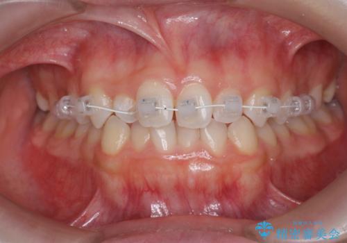 前歯のガタつき・ねじれを治すマウスピース矯正の治療中