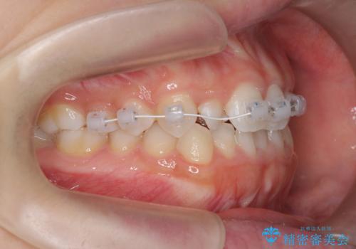 前歯のガタつき・ねじれを治すマウスピース矯正の治療中
