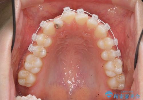 前歯のガタつき・ねじれを治すマウスピース矯正の治療中