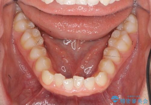 前歯のガタつき・ねじれを治すマウスピース矯正の治療中