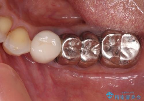 抜かずに保存した奥歯が痛くて臭う　セラミックブリッジによる欠損補綴治療の症例 治療前