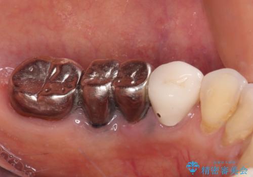 抜かずに保存した奥歯が痛くて臭う　セラミックブリッジによる欠損補綴治療の治療前