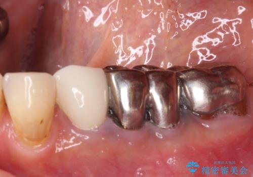 抜かずに保存した奥歯が痛くて臭う セラミックブリッジによる欠損補綴治療の治療前
