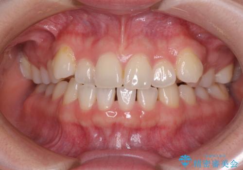 奥歯の欠損を放置 大臼歯を抜歯した矯正治療の症例 治療前