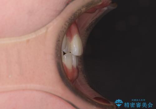 奥歯の欠損を放置 大臼歯を抜歯した矯正治療の治療前