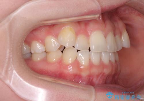 奥歯の欠損を放置 大臼歯を抜歯した矯正治療の治療前