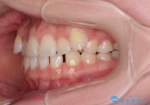 奥歯の欠損を放置 大臼歯を抜歯した矯正治療の治療前