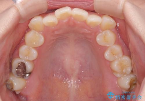 奥歯の欠損を放置 大臼歯を抜歯した矯正治療の治療前