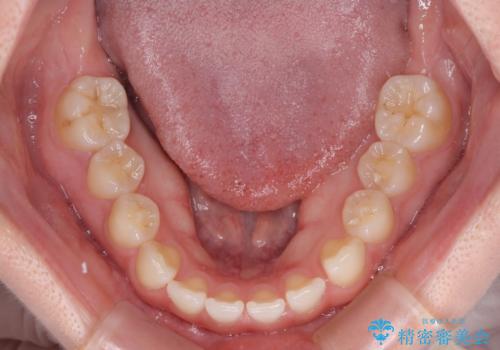 奥歯の欠損を放置 大臼歯を抜歯した矯正治療の治療前