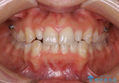 矮小歯を綺麗な歯に。矯正とセラミックの総合治療の治療中