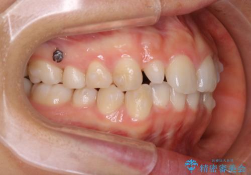 矮小歯を綺麗な歯に。矯正とセラミックの総合治療の治療中