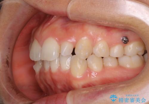 矮小歯を綺麗な歯に。矯正とセラミックの総合治療の治療中