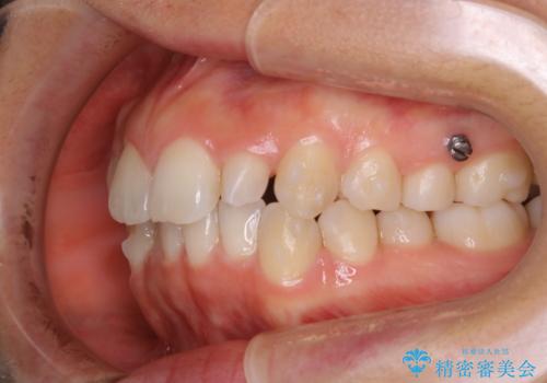 矮小歯を綺麗な歯に。矯正とセラミックの総合治療の治療中