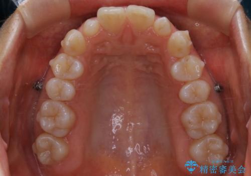 矮小歯を綺麗な歯に。矯正とセラミックの総合治療の治療中