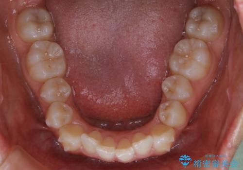 矮小歯を綺麗な歯に。矯正とセラミックの総合治療の治療中