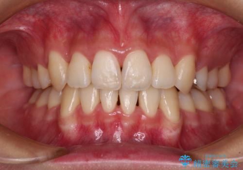 前歯の歯並びを治したい ワイヤー装置での抜歯矯正の症例 治療後