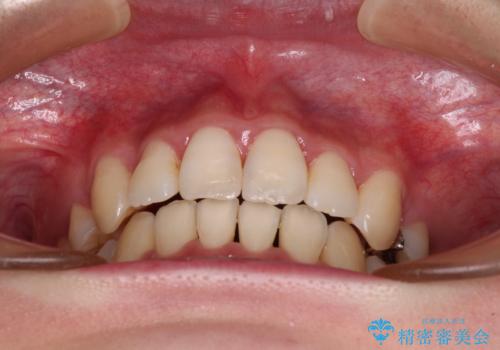 前歯の歯並びを治したい ワイヤー装置での抜歯矯正の治療後