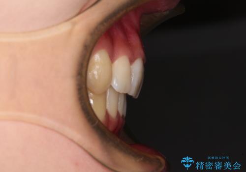 前歯の歯並びを治したい　ワイヤー装置での抜歯矯正の治療後