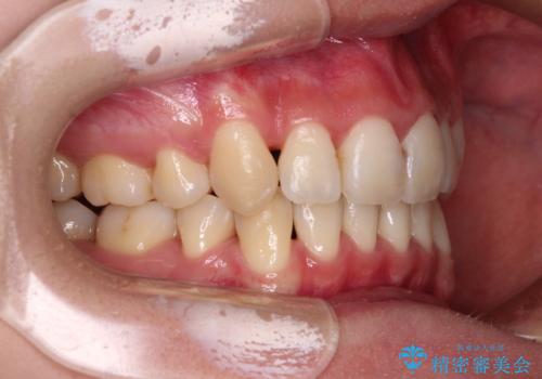 前歯の歯並びを治したい ワイヤー装置での抜歯矯正の治療後