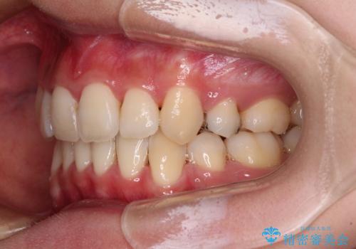 前歯の歯並びを治したい ワイヤー装置での抜歯矯正の治療後