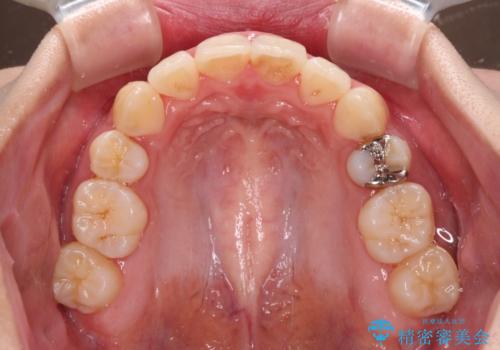 前歯の歯並びを治したい ワイヤー装置での抜歯矯正の治療後