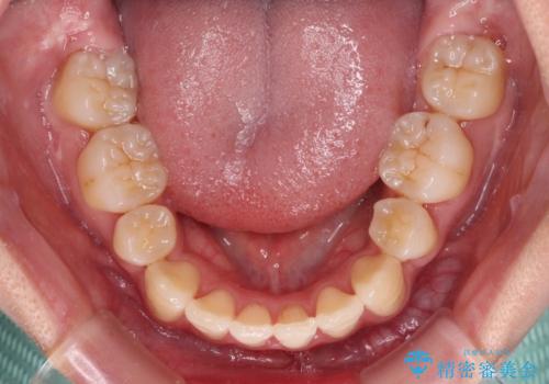 前歯の歯並びを治したい ワイヤー装置での抜歯矯正の治療後