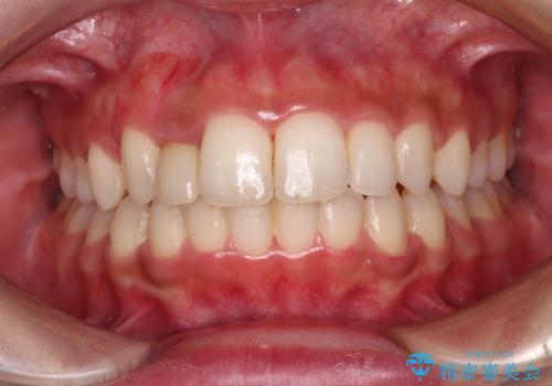 抜けてしまうと言われた前歯 インビザラインによる矯正治療の症例 治療後