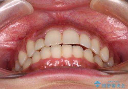 抜けてしまうと言われた前歯 インビザラインによる矯正治療の治療後