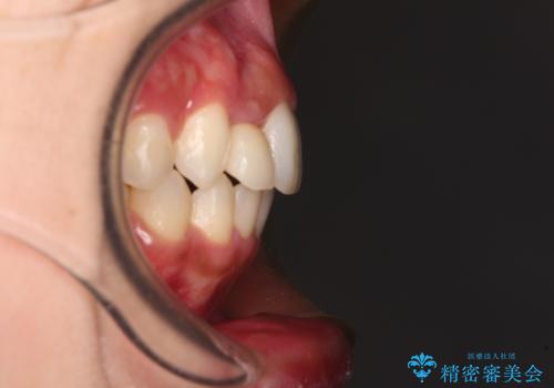 抜けてしまうと言われた前歯 インビザラインによる矯正治療の治療後
