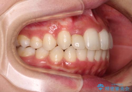 抜けてしまうと言われた前歯 インビザラインによる矯正治療の治療後