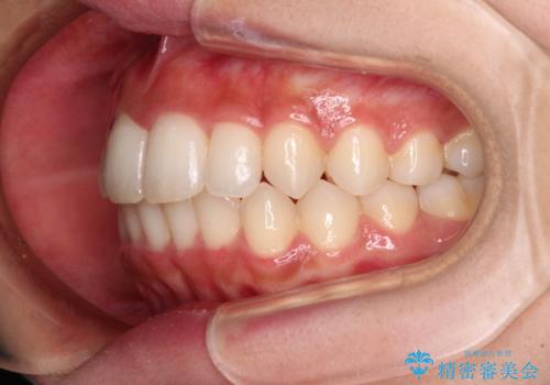 抜けてしまうと言われた前歯 インビザラインによる矯正治療の治療後