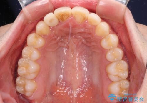 抜けてしまうと言われた前歯 インビザラインによる矯正治療の治療後