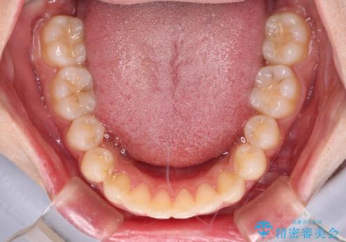 抜けてしまうと言われた前歯 インビザラインによる矯正治療の治療後