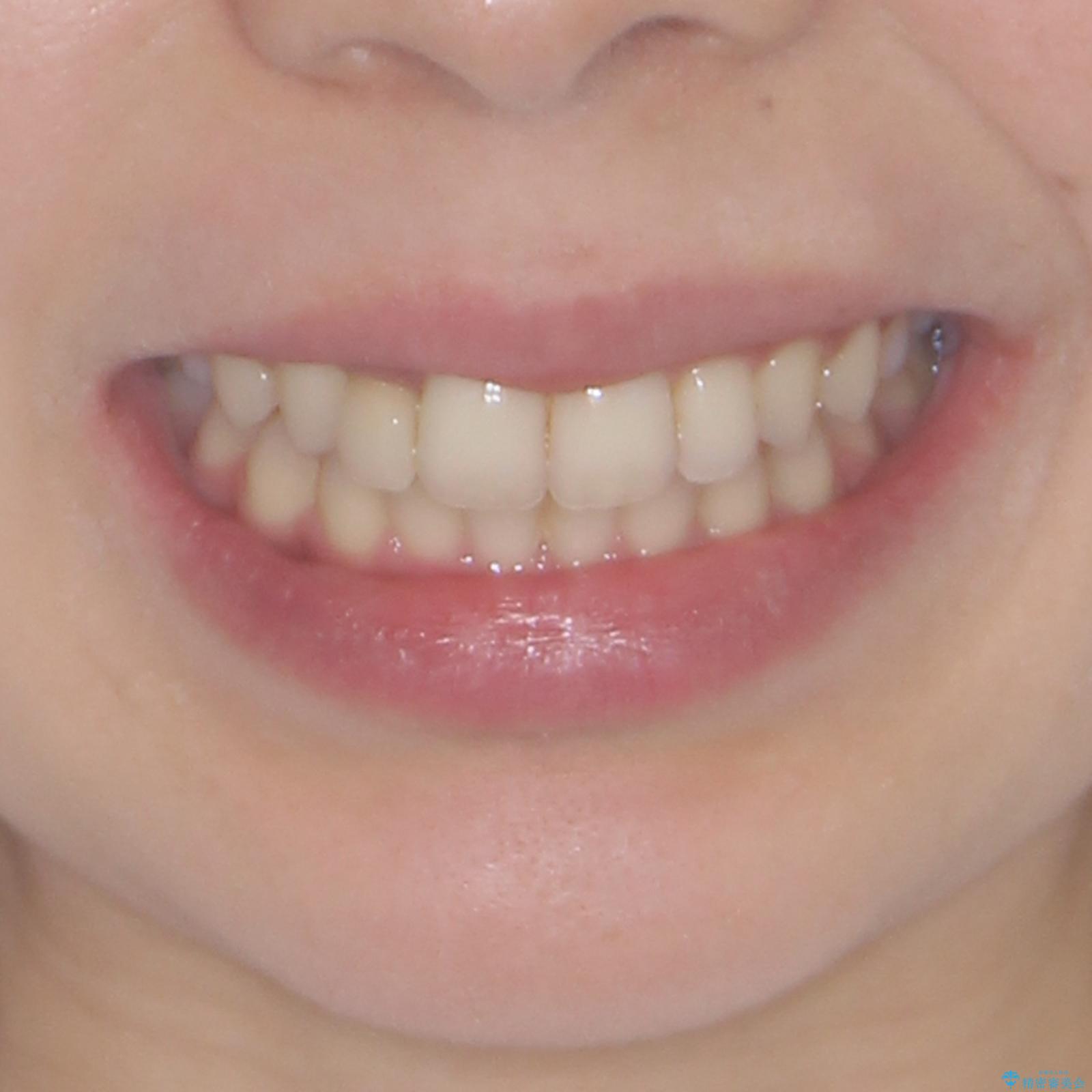 抜けてしまうと言われた前歯 インビザラインによる矯正治療の治療後(顔貌)