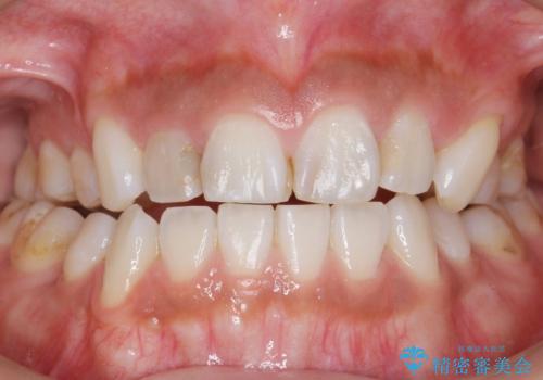 前歯の色と隙間が気になる 早く治したい 矯正は嫌 30代女性