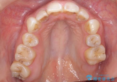 前歯の色と隙間が気になる　早く治したい　矯正は嫌　30代女性の治療前