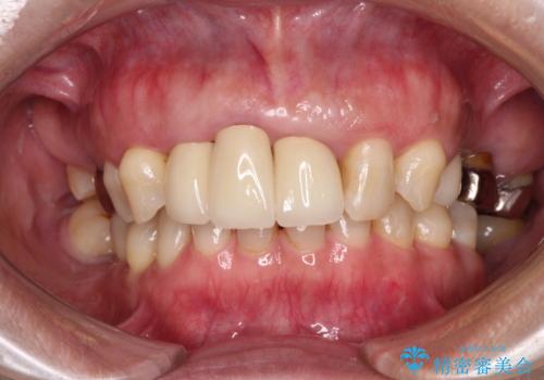 歯茎の縁に見える変色を隠したい 前歯のオールセラミッククラウンの治療後